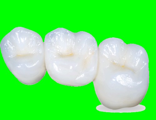روکش سرامیکی دندان چیست 