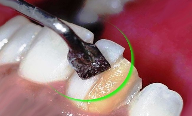 معایب برداشتن لمینت دندان چیست