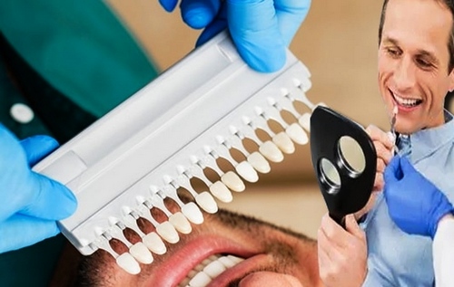 مراحل قرار دادن لمینت دندان چگونه است 