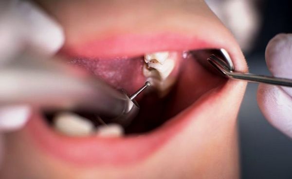 پوسیدگی دندان و ژنتیک