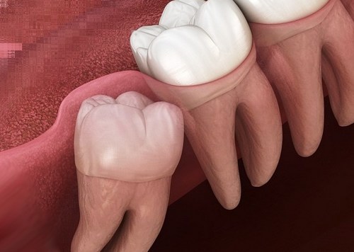 دلیل درد گرفتن دندان عقل به همراه کاهش درد دندان با راهکار خانگی