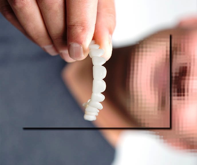طول عمر لمینت موقت دندانی چند سال است