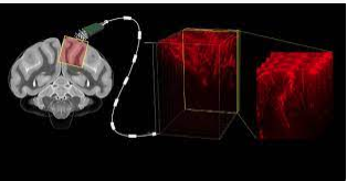  سونوگرافی عروق مغزی چگونه انجام میشود؟