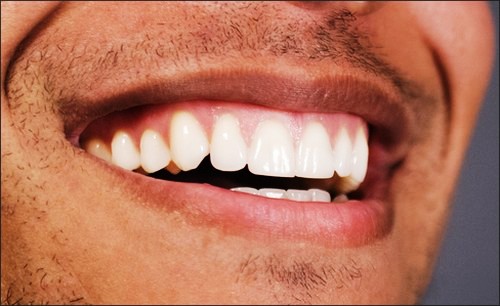 راهای سفید کردن دندان مردان